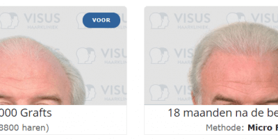 Haarimplantatie