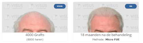 Haarimplantatie